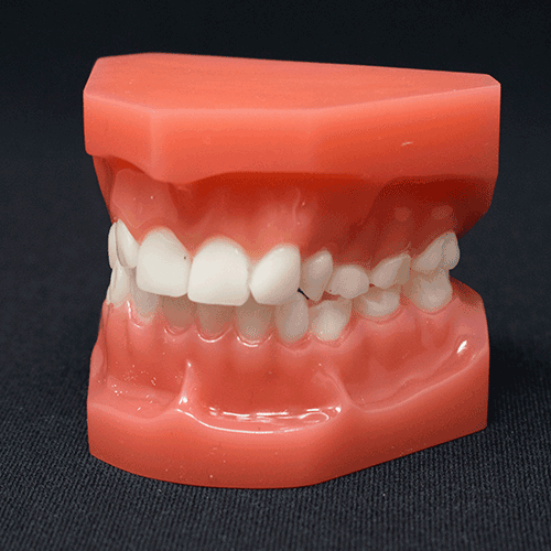 Orthodontic Typodont Class 2 Division 2 Mixed Dentition BoneModels™